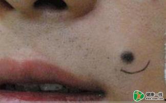 针挑开超臭大黑疮视频,惊心动魄的祛病瞬间